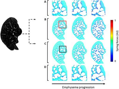 A Personalized Spring Network Representation of Emphysematous Lungs From CT Images